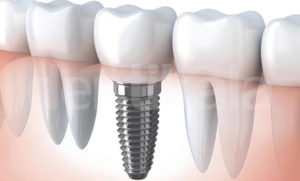 بررسی چهار نوع بریج دندان
